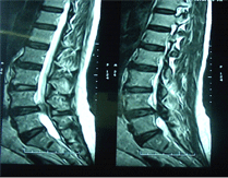 BrainTumour/Cancer, Stereotactic Neuro Surgery, Brain Surgery, Pituitary Tumours, Surface Tumours, Cerebellopentive angle tumours, Foramen Magnum Tumours, Cerebro Vascular Surgery, Neuro Cosmetic Sugery, Facial Pain Disc-prolapsc, Back Pain, Neck Pain, Lumbar spondylolisthesis, Low Back Pain, Radiculopathy, TB spine(Tuberclosis), Back ache, neck ache, spinetumours + spinal chord tumours, spinal chord injury, Micro discetomy, endoscopic discetomy, spinal fusion, spinal stafilization, cervical discetomy fusion, Spinal instrumentation, Tumours, Surgery, Neuro Surgery, Cancer, Treatement, Spinal Surgery, Vascular, Discetomy
