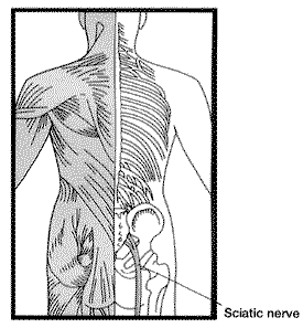 sciatica