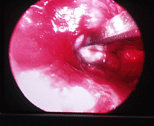 BrainTumour/Cancer, Stereotactic Neuro Surgery, Brain Surgery, Pituitary Tumours, Surface Tumours, Cerebellopentive angle tumours, Foramen Magnum Tumours, Cerebro Vascular Surgery, Neuro Cosmetic Sugery, Facial Pain Disc-prolapsc, Back Pain, Neck Pain, Lumbar spondylolisthesis, Low Back Pain, Radiculopathy, TB spine(Tuberclosis), Back ache, neck ache, spinetumours + spinal chord tumours, spinal chord injury, Micro discetomy, endoscopic discetomy, spinal fusion, spinal stafilization, cervical discetomy fusion, Spinal instrumentation, Tumours, Surgery, Neuro Surgery, Cancer, Treatement, Spinal Surgery, Vascular, Discetomy