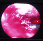 BrainTumour/Cancer, Stereotactic Neuro Surgery, Brain Surgery, Pituitary Tumours, Surface Tumours, Cerebellopentive angle tumours, Foramen Magnum Tumours, Cerebro Vascular Surgery, Neuro Cosmetic Sugery, Facial Pain Disc-prolapsc, Back Pain, Neck Pain, Lumbar spondylolisthesis, Low Back Pain, Radiculopathy, TB spine(Tuberclosis), Back ache, neck ache, spinetumours + spinal chord tumours, spinal chord injury, Micro discetomy, endoscopic discetomy, spinal fusion, spinal stafilization, cervical discetomy fusion, Spinal instrumentation, Tumours, Surgery, Neuro Surgery, Cancer, Treatement, Spinal Surgery, Vascular, Discetomy