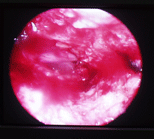 BrainTumour/Cancer, Stereotactic Neuro Surgery, Brain Surgery, Pituitary Tumours, Surface Tumours, Cerebellopentive angle tumours, Foramen Magnum Tumours, Cerebro Vascular Surgery, Neuro Cosmetic Sugery, Facial Pain Disc-prolapsc, Back Pain, Neck Pain, Lumbar spondylolisthesis, Low Back Pain, Radiculopathy, TB spine(Tuberclosis), Back ache, neck ache, spinetumours + spinal chord tumours, spinal chord injury, Micro discetomy, endoscopic discetomy, spinal fusion, spinal stafilization, cervical discetomy fusion, Spinal instrumentation, Tumours, Surgery, Neuro Surgery, Cancer, Treatement, Spinal Surgery, Vascular, Discetomy