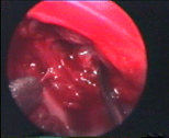 BrainTumour/Cancer, Stereotactic Neuro Surgery, Brain Surgery, Pituitary Tumours, Surface Tumours, Cerebellopentive angle tumours, Foramen Magnum Tumours, Cerebro Vascular Surgery, Neuro Cosmetic Sugery, Facial Pain Disc-prolapsc, Back Pain, Neck Pain, Lumbar spondylolisthesis, Low Back Pain, Radiculopathy, TB spine(Tuberclosis), Back ache, neck ache, spinetumours + spinal chord tumours, spinal chord injury, Micro discetomy, endoscopic discetomy, spinal fusion, spinal stafilization, cervical discetomy fusion, Spinal instrumentation, Tumours, Surgery, Neuro Surgery, Cancer, Treatement, Spinal Surgery, Vascular, Discetomy