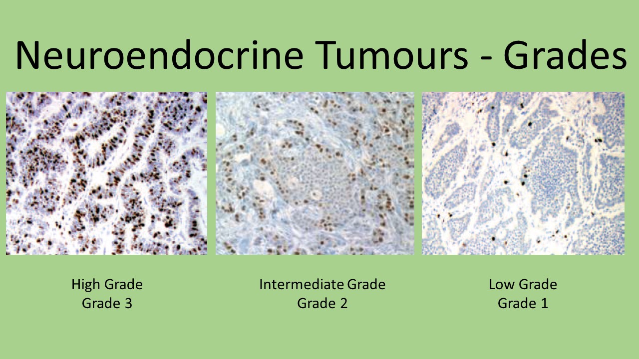 Neuroendocrine Carcinomas