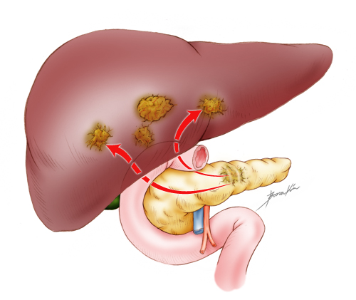 Neuroendocrine Carcinomas1