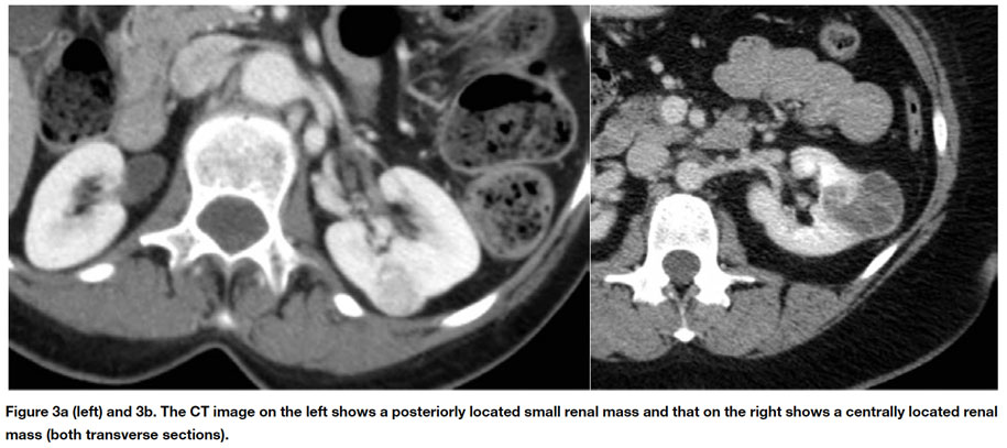 Small Renal Mass Fig 3 - CT Image