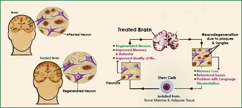 Brain Injuries