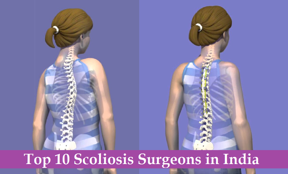 Top 10 Scoliosis Surgeons in India