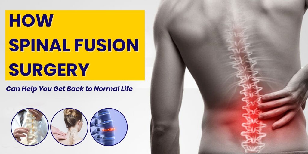 How Spinal Fusion Surgery Can Help You Get Back to Normal Life