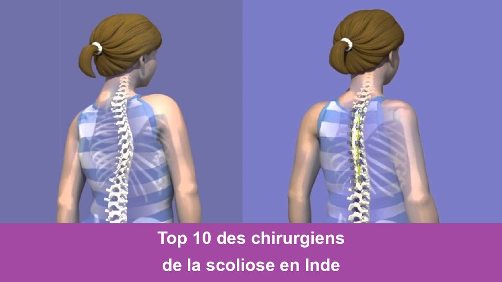 Top 10 des chirurgiens de la scoliose en Inde