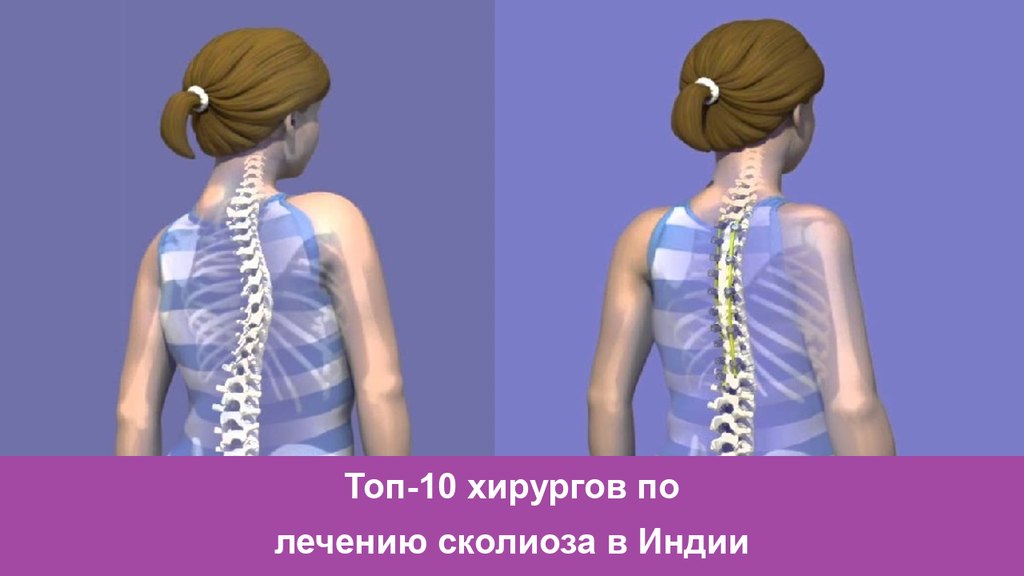 Топ-10 хирургов по лечению сколиоза в Индии